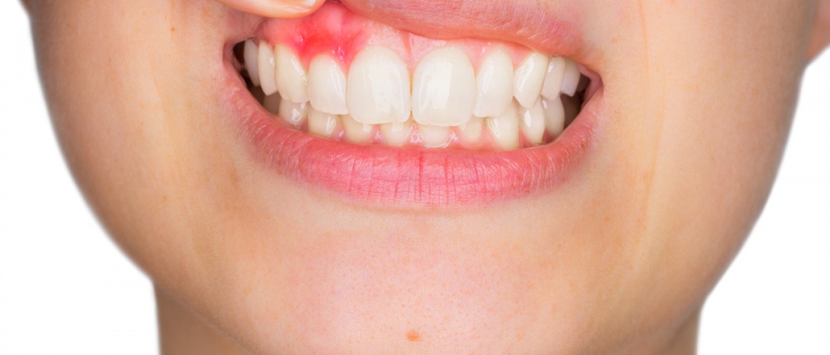 Eine Frau hat eine Zahnfleischentzündung in ihrem Oberkiefer