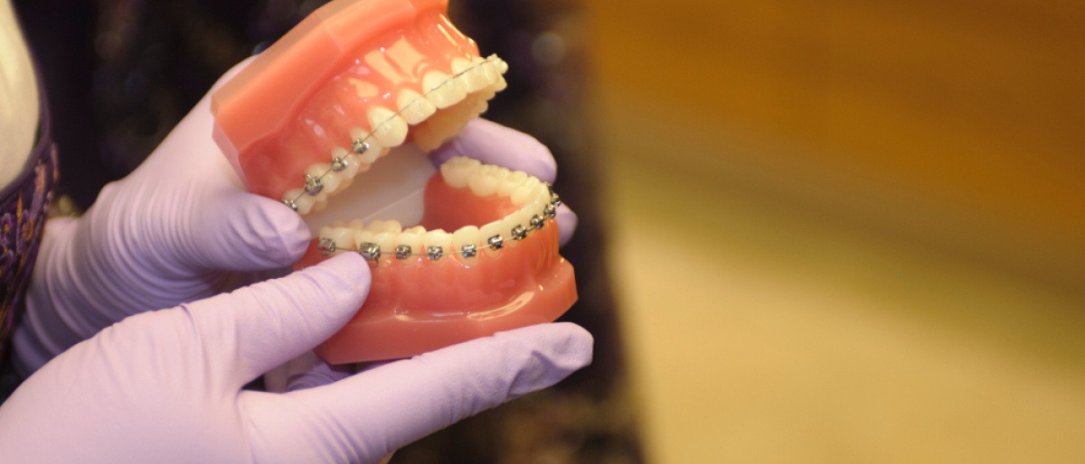 Eine Frau hält ein Modell eines Gebisses mit Damon Brackets