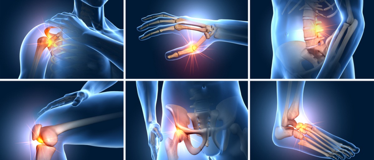 Eine Grafik zeigt die Gelenke, die bei Arthrose Schmerzen haben