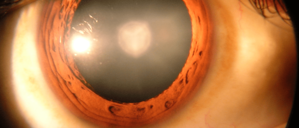 Ein Auge mit der Krankheit Grauer Star (Katarakt) ist zu sehen