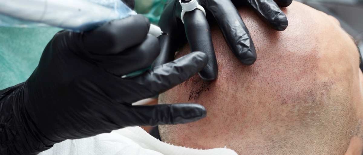 Bei einem Mann werden Haare pigmentiert