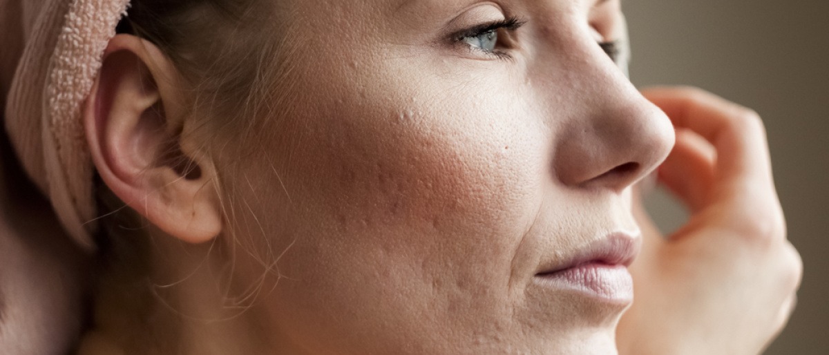 Rosacea überschminken
