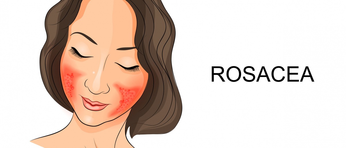 Eine Frau hat Rosacea