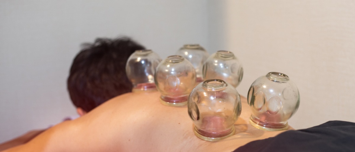 Ein Mann wird mit einer Schröpftherapie behandelt