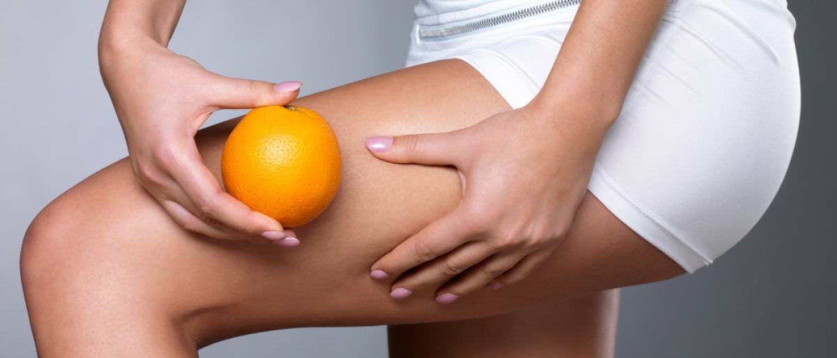 Besonders Frauen haben das Problem: Cellulite oder Orangenhaut