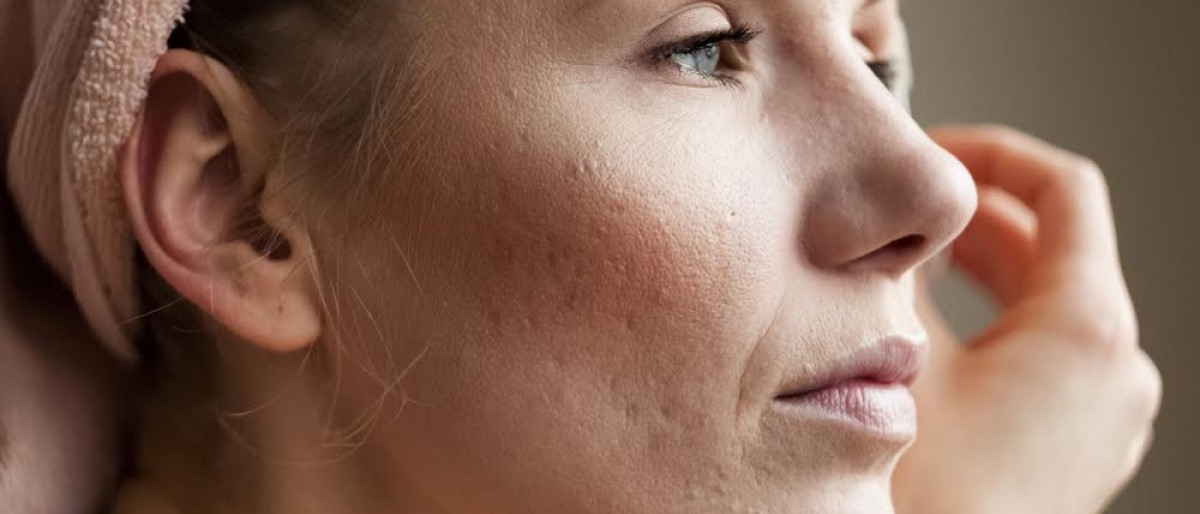 Narben überschminken Ein spezielles Makeup machts möglich