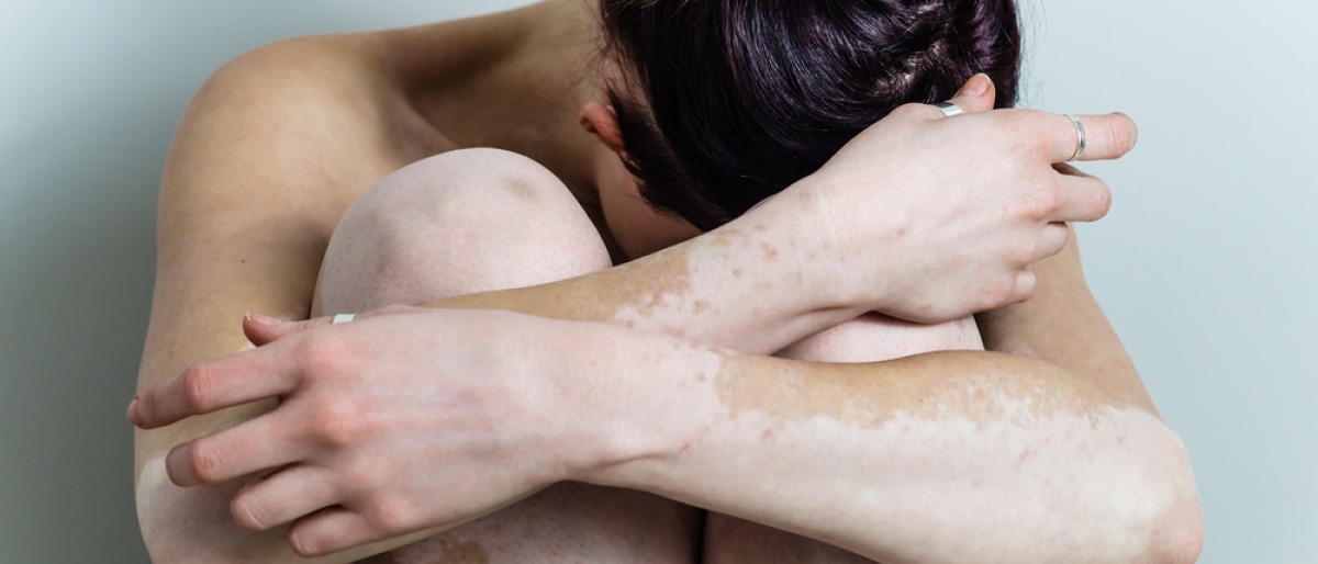Eine Frau mit Weißfleckenkrankheit (Vitiligo) sitzt 
