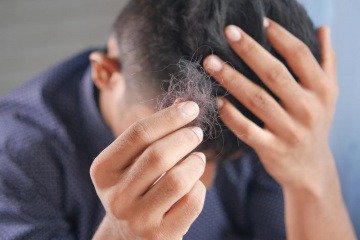 Ein Mann hält ein Büschel ausgefallener Haare in der Hand