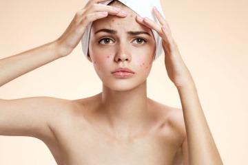 Akne Creme ist die erste Hilfe gegen Hautunreinheiten