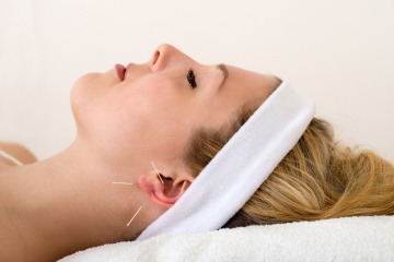 Eine Frau wird mit Akupunkturnadeln am Ohr zum Abnehmen behandelt