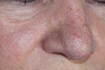 Ein Gesicht mit Couperose