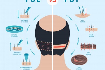 Schema von FUE- und FUT-Haartransplantation
