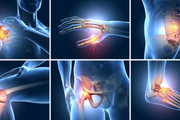 Eine Grafik zeigt die Gelenke, die bei Arthrose Schmerzen haben