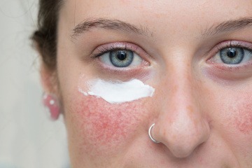 Creme zur Hautpflege auf Gesicht mit Rosazea