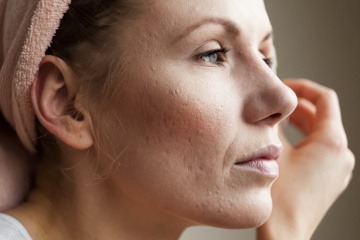 Rosacea überschminken