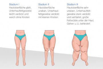 Die Stadien eines Lipödems sind zu sehen