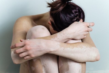 Eine Frau mit Weißfleckenkrankheit (Vitiligo) sitzt 
