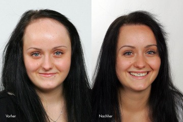 Eine Frau ist auf einem Vorher-Nachher Foto (Haartransplantation bei Frauen)
